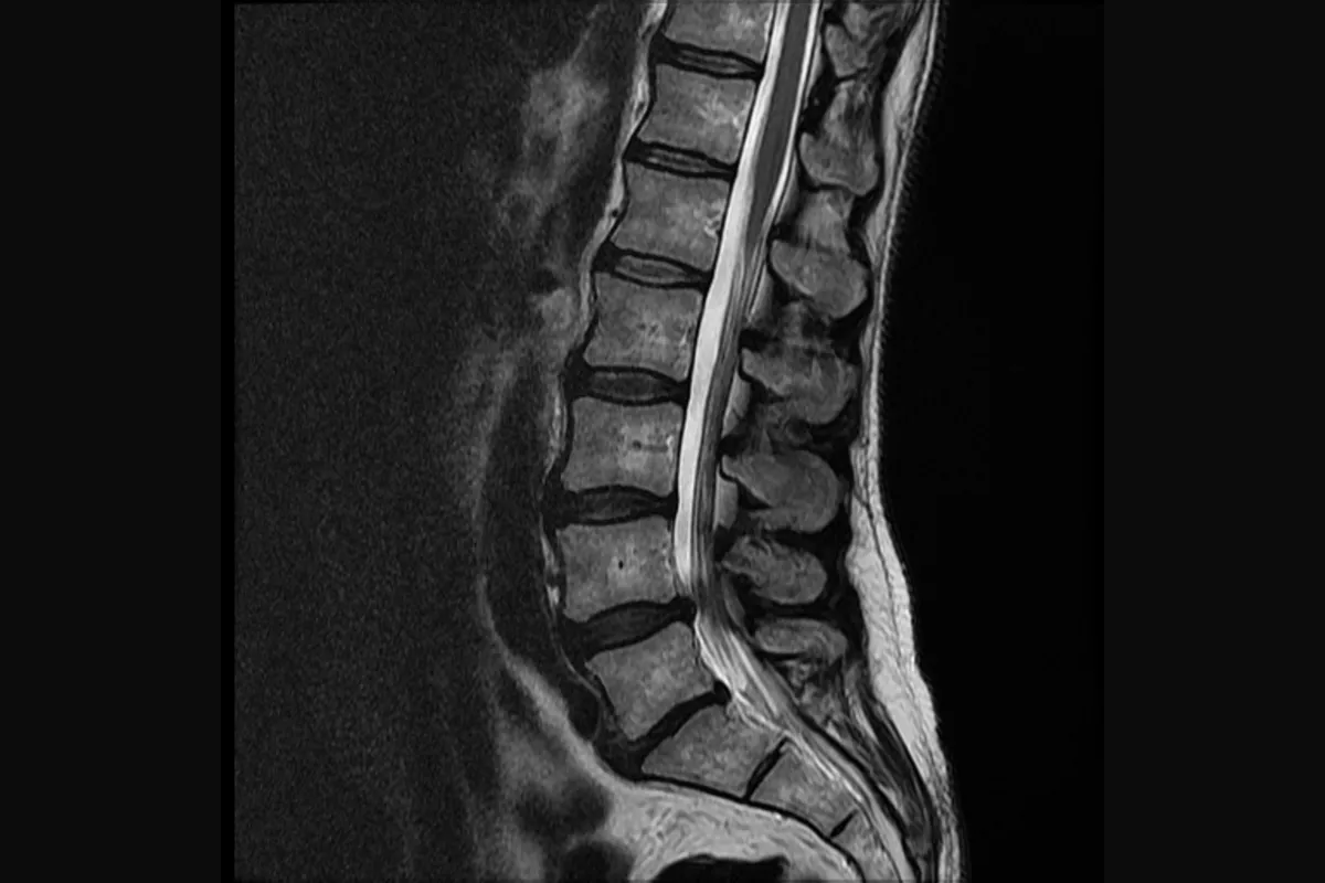 Реальный снимок МРТ поясницы: верхние диски светлые, два нижних диска тёмные на Т2
